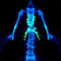 Detecting Radiation Esophagitis Using 18F-FAPI-04 PET