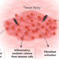 Calluna Pharma starts efficacy test with unique IPF antibody